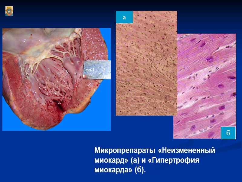 Микропрепараты «Неизмененный миокард» (а) и «Гипертрофия миокарда» (б).  а б